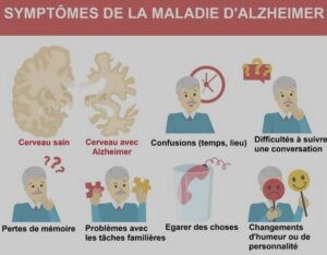 Les symptômes de la maladie d'Alzheimer - La Gériatrie