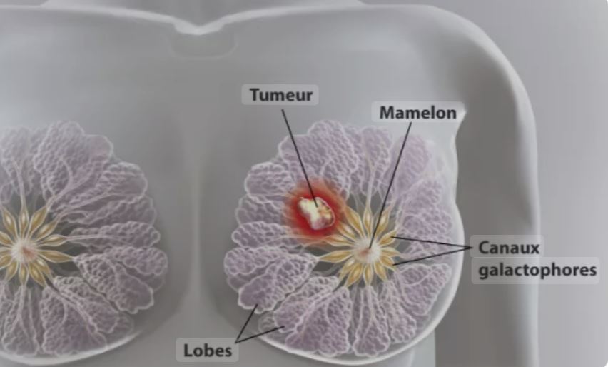 Cancer du sein