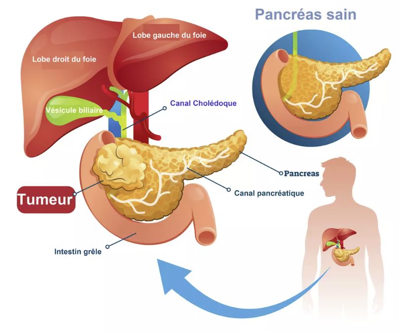cancer du pancréas