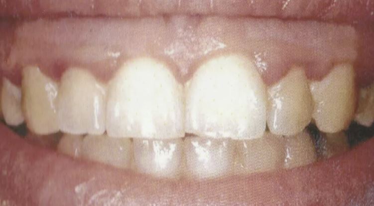 La Maladie des Gencives chez les Séniors