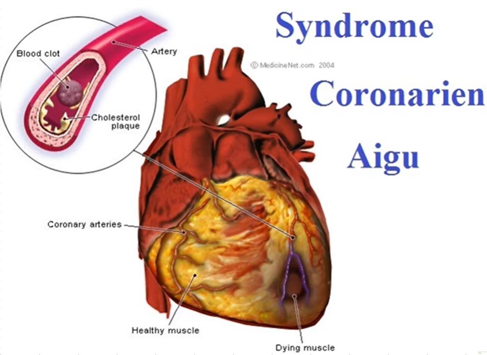 Syndrome Coronarien Aigu SCA