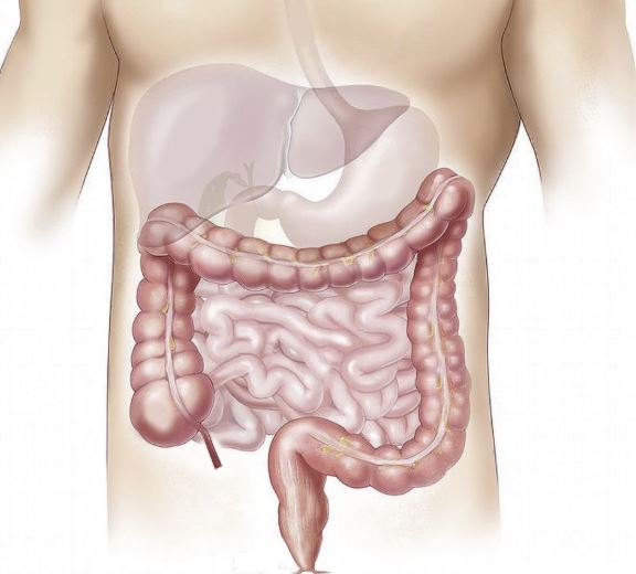 Syndrome de l’intestin irritable